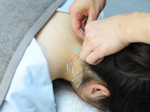 鍼灸院 整骨院ティップ 春日院/痛みやしびれに効果的な鍼施術