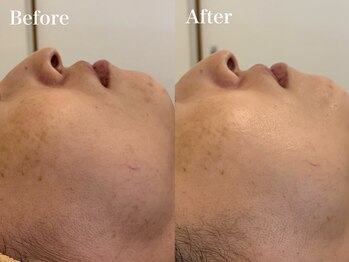 ラヴィエ ベル(La vie est belle)/REVI陶肌トリートメント