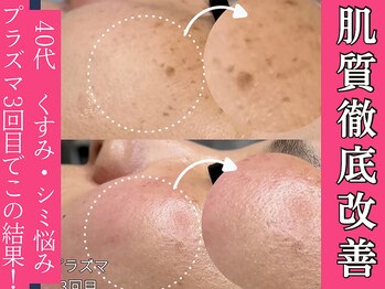 ハス(hasu.)/シミ緩和♪くすみOFF！