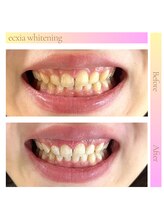 エクシアホワイトニング 横浜駅西口店/ホワイトニングビフォーアフター