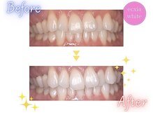エクシアホワイトニング エミフルMASAKI店/ホワイトニングビフォーアフター