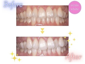 エクシアホワイトニング エミフルMASAKI店/ホワイトニングビフォーアフター