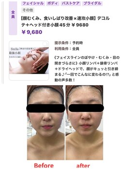 ステラ(Stella)/1回目小顔施術