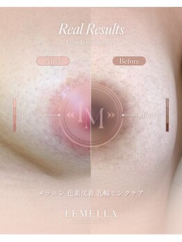 モア(more.)の写真/《顔と同じように、デリケートゾーンも透明感UP★》VIOや乳輪、ワキの黒ずみ悩みに専門ケアという選択を◎