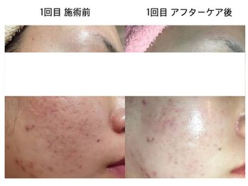 ファロンビューティー(fallon beauty)/ハーブピーリング