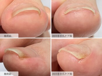 巻き爪改善ケア