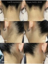 エムズスタイル ネイルバー(M's Style NAIL BAR)/うなじ脱毛