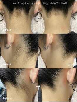 エムズスタイル ネイルバー(M's Style NAIL BAR)/うなじ脱毛