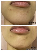 アンフィー 川西能勢口店(Une f`ee)/フォト美顔のビフォーアフター★