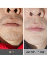 キムラケ 和光別邸(木村家 KIMURAKE)/メンズ脱毛ヒゲビフォーアフター