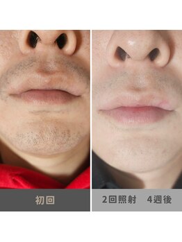 キムラケ 和光別邸(木村家 KIMURAKE)/メンズ脱毛ヒゲビフォーアフター