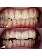 ホワイトニングカフェ 吉祥寺店(WhiteningCafe)/8回コース / ビフォーアフター