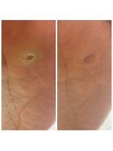 ドクターネイル爪革命 十条店/魚の目ケア