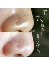 アーフ(ARF)/肌質改善