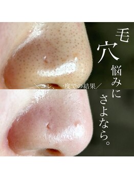 アーフ(ARF)/肌質改善