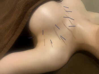 りっつ鍼灸院/お胸ふっくら！バストアップ鍼