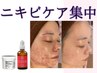 【繰り返すしつこいニキビ予防に】オプション付きハーブピーリング ¥18700→