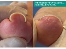 地爪ケアクリニックサロン 代々木店/巻き爪でお悩みの方に！