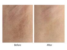 オーシャンブルー 大分店(OCEAN BLUE)/最新黒ずみケア《ローマピンク》