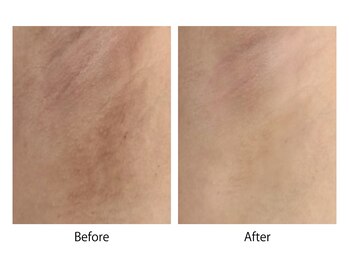 オーシャンブルー 大分店(OCEAN BLUE)/最新黒ずみケア《ローマピンク》