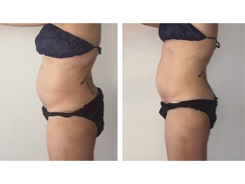 アイリーボーテ 東大阪(アイリーBEAUTE)/痩身　ノンFクリーム使用