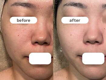 サンゴ(Sango)/ニキビ/毛穴/ざらつきの改善