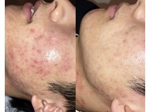 ブブオム 恵比寿本店(BUB OMME)/アクアダーマ