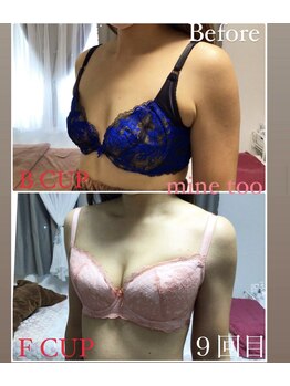 マイントゥー(mine too)/バストアップ症例