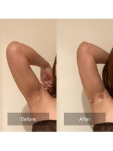 アラマンダ(Allamanda)/二の腕BeforeAfter