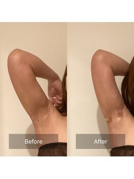 アラマンダ(Allamanda)/二の腕BeforeAfter