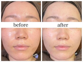 アリエス/ハイドラ×顔脱毛1回の変化