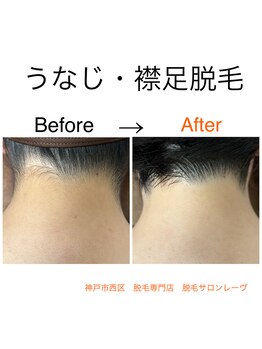 レーヴ/脱毛で後ろ姿も美人に☆