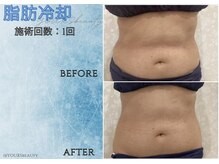 ユアーズビューティー(YOURS beauty)/脂肪冷却