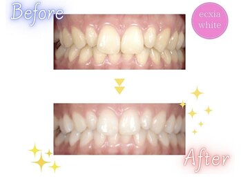 エクシアホワイトニング エミフルMASAKI店/ホワイトニングビフォーアフター
