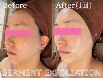 ルナステラ 七尾店/セルマン艶肌ピーリング