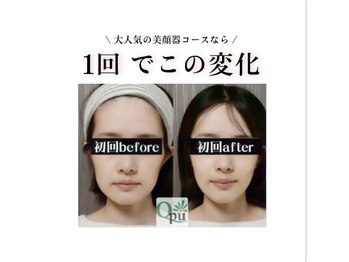 キュープ 北千住店(Qpu)の写真/ほうれい線・たるみにアプローチ!美肌も叶える美顔器コースで、あなたにご褒美を♪