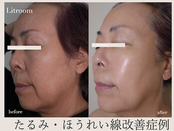 リトルーム(Litroom: from Seoul)の写真/年齢とともにハリがなく乾燥が気になる・シワが気になる方に。ほうれい線ケアも◎弾力と艶を併せ持つ肌へ