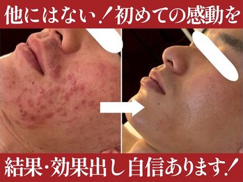 スリーウェルスラボ 恵庭店(THREE wealth lab)の写真/都度払いOK♪【全顔肌育♪ハーブピーリング＋ハイドロ毛穴洗浄★￥7700】黒ずみ徹底除去＋効果出しに自信