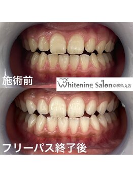 ホワイトニングサロン 京都烏丸店/ホワイトニング施術例
