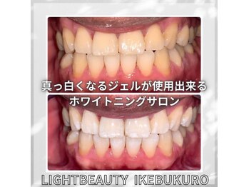 ライトビューティー 池袋店(LightBeauty)/症例写真