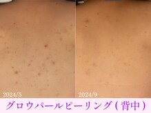 オーシャンブルー 大分店(OCEAN BLUE)/グロウパールピーリング(背中)