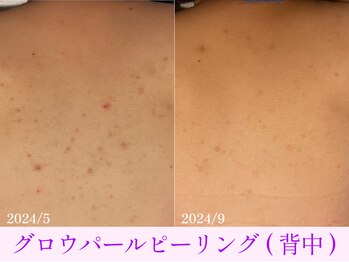 オーシャンブルー 大分店(OCEAN BLUE)/グロウパールピーリング(背中)