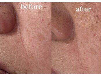 ルアーナ(Luana)/しわケア ハーブピーリング