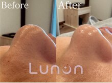 ルノン(Lunon)/毛穴洗浄ハイドロ