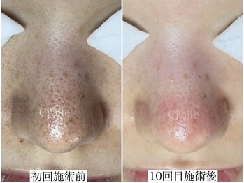 シエール 調布(Ci'aile)/毛穴集中ケア