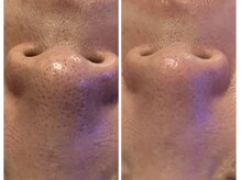 ラナチュールの雰囲気（ハイドラ×プラズマ照射で毛穴の汚れが落ちお肌もトーンアップ）