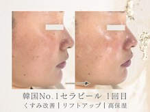 アネラボーテ(Anela Beaute)/セラピール1回目★透明感UP
