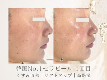 アネラボーテ(Anela Beaute)/セラピール1回目★透明感UP