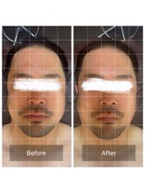 ラビ(RABBI)/40代男性　小顔矯正　