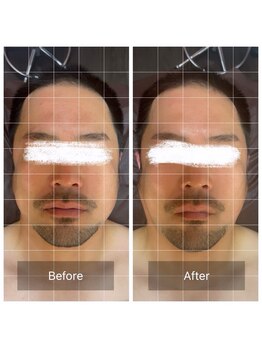 ラビ(RABBI)/40代男性　小顔矯正　